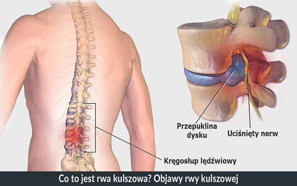 Rwa kulszowa